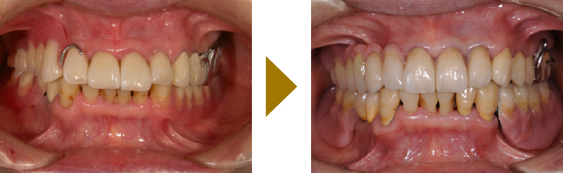 安定感や噛み心地に優れたPAアタッチメント義歯の症例