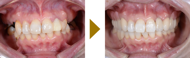 奥歯がない状態でPAアタッチメント義歯を使用した症例