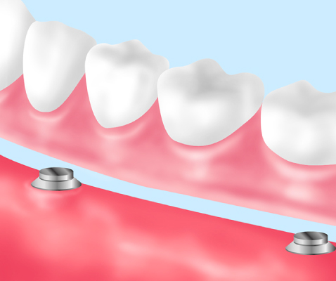 磁性アタッチメントの総入れ歯
