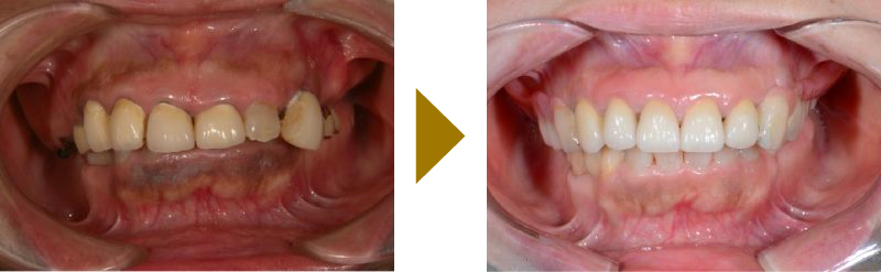 奥歯の欠損へのコーヌスクローネ義歯を用いた症例