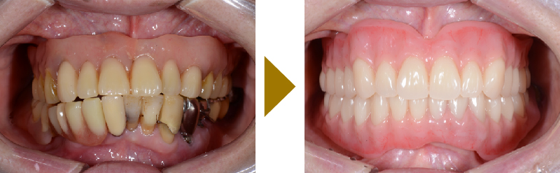 噛み合わせを再構築し噛める様にしたコーヌスクローネ義歯の症例