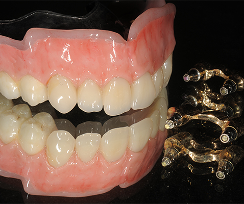 自然な歯と歯茎の色を再現します