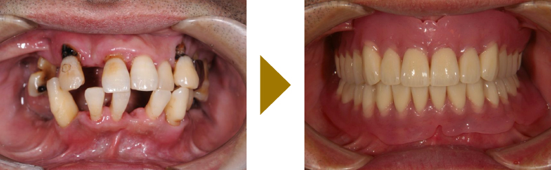 特殊プラスチック義歯の症例